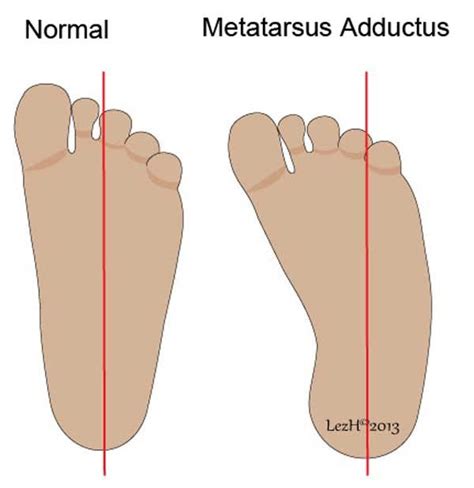 metatarsus adductus - USA News Collections