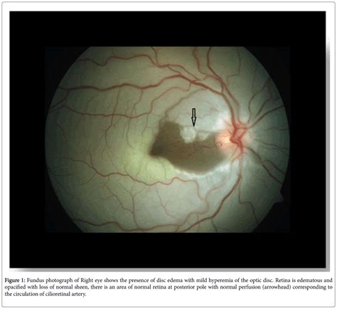 Central Retinal Artery Occlusion with Patent Cilioretinal Artery