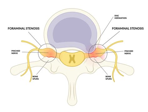 Intervertebral Foramen Cervical