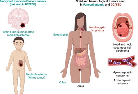 Fanconi Anemia Symptoms