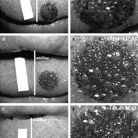 Fungiform papillae in a human tongue. (A) Tongue with midline... | Download Scientific Diagram