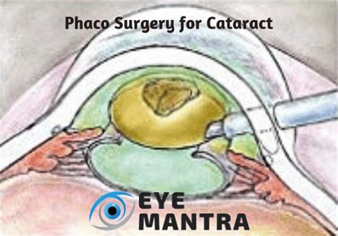 Phacoemulsification Surgery | Diagnosis and Procedure | EyeMantra