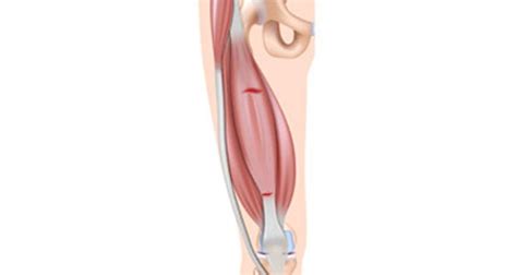 Thigh Muscle Strain Treatment & Rehabilitation