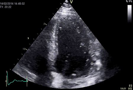 Ecocardiograma de esfuerzo - CardioQuirón - Servicio de Cardiología de los Hospitales ...