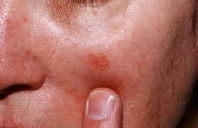 Actinic Keratosis Treatment — Academic Alliance In Dermatology