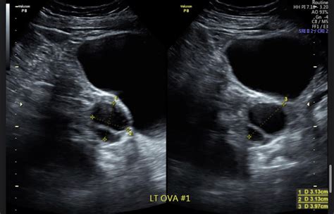 Septated ovarian cyst : r/hysterectomy