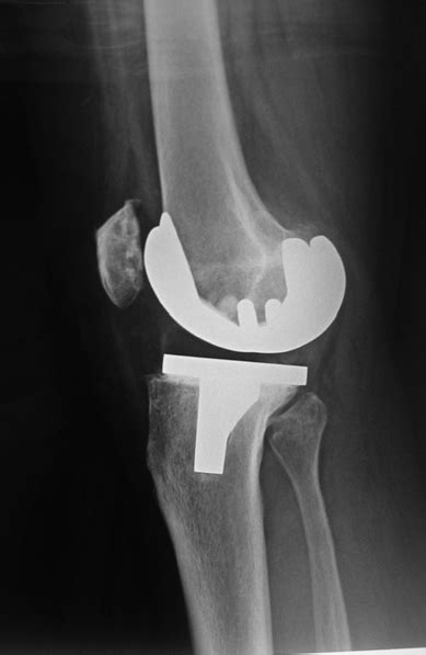 Complications After Total Knee Arthroplasty - TeachMe Orthopedics