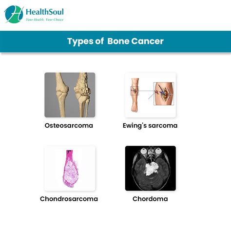 Bone Cancer: Symptoms and Treatment – Healthsoul