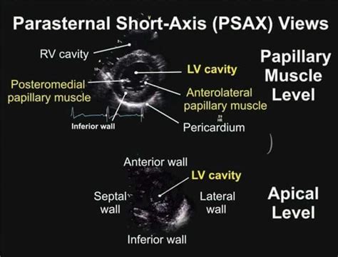 Parasternal Short Axis View TEE | Ultrasound, Medical ultrasound ...