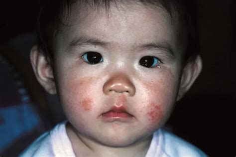 Atopic Dermatitis Picture Image on MedicineNet.com