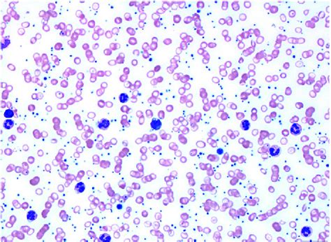 Hem6 Peripheral Blood Smear Wright Giemsa Stained Per - vrogue.co