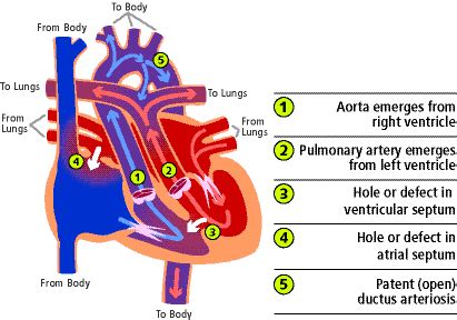 Transposition of the Great Arteries | CS Mott Children's Hospital | Michigan Medicine