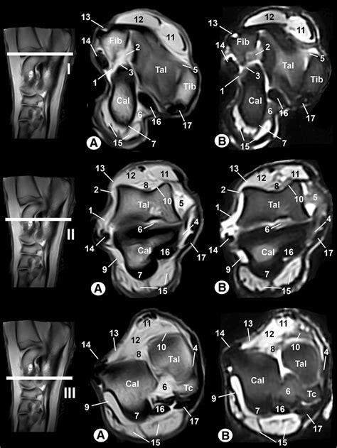 Transverse MR images of the right tarsal joint: a SE T1-weighted and... | Download Scientific ...