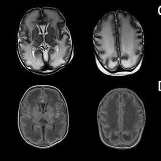 Wernicke Encephalopathy: MRI in a sixteen weeks pregnant woman with ...