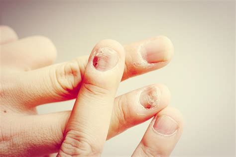 Nail fungal infection: Causes, treatment, and symptoms