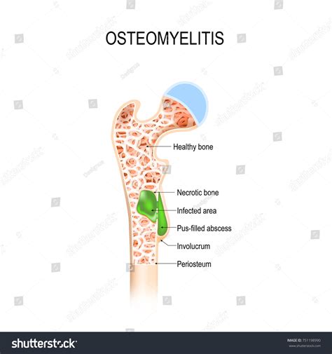 Osteomyelitis Infection Bone Vector Diagram Shows Stock Vector (Royalty Free) 751198990 ...