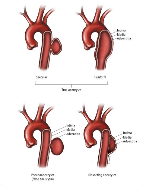 Aortic Aneurysms - Aortic Diseases - Vascular Diseases, Peripheral - Cardiovascular Diseases ...