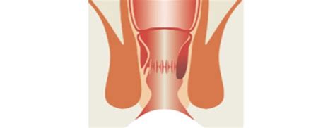 Stage Ii Hemorrhoids Internal