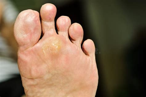 Wart Under Foot Can Treatment by Salicylic Acid Stock Image - Image of ...