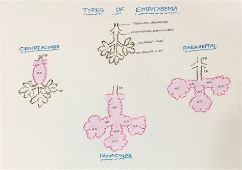 Emphysema – Histopathology.guru