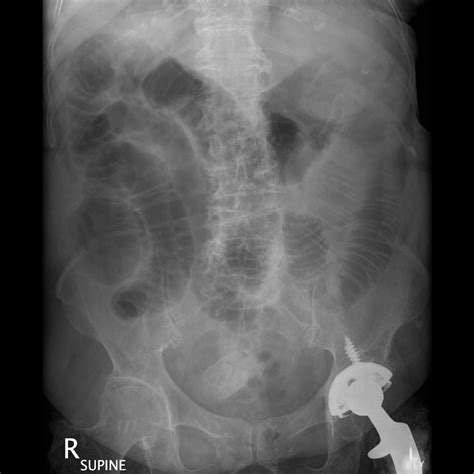 Gallstone ileus | Image | Radiopaedia.org