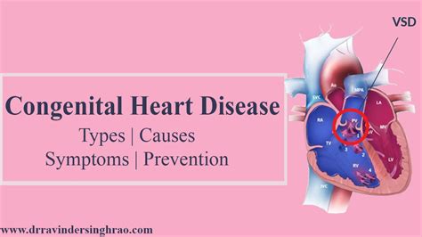 Congenital Heart Disease Symptoms Causes And Treatment – NBKomputer