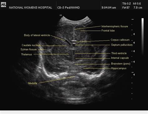 Fetal Head Ultrasound