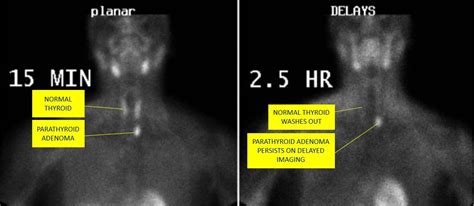 Parathyroid scan adenoma example labeled | Nuclear medicine, Nuclear med, Medicine