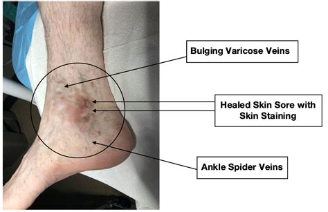 What to look for #8 - Spider Veins Skin Sore Staining Bulging Varicose Veins