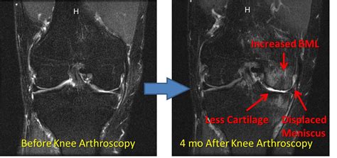 Knee Surgery Complications: Watch a Knee Go from Slightly Abnormal to a Mess in 4 Months ...