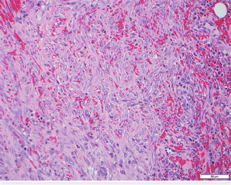 Extensive hemorrhage with hemosiderin deposition composed of a ...