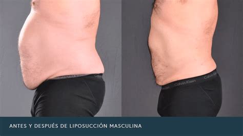 Represalias vestir índice liposuccion hombres antes y despues Parecer Admitir Donación