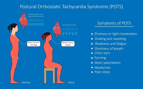 Postural Orthostatic Tachycardia Syndrome - Finapres