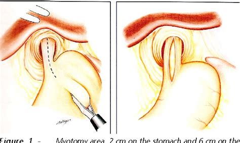 Figure 1 from Quality of life after Heller-Dor ’ s cardiomiotomy | Semantic Scholar