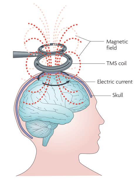 Transcranial magnetic stimulation - HCE Wiki - The Human Cognitive Enhancement Wiki