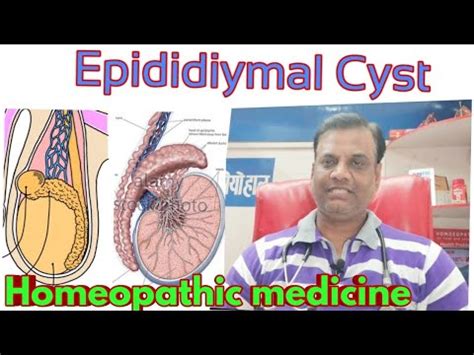 EPIDIDYMAL CYST- Cause , Symptom , Homeopathic Medicine - YouTube