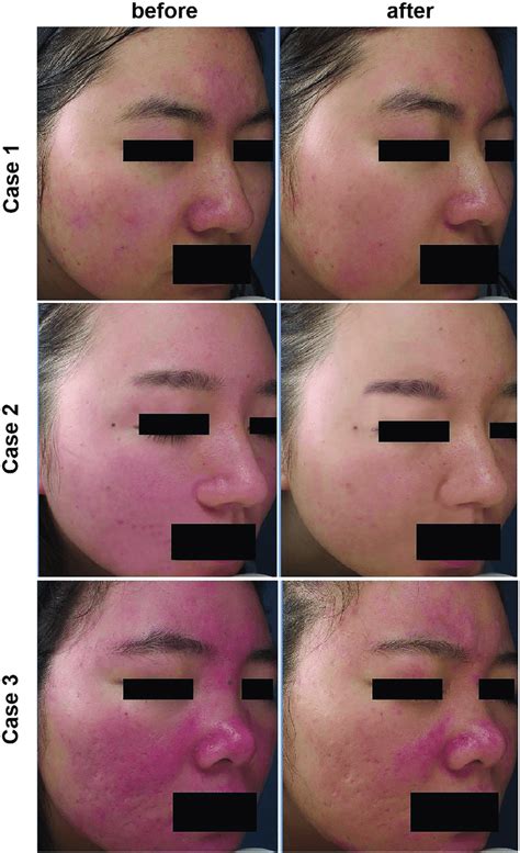 Pictures of three rosacea patients before and after IPL treatment ...