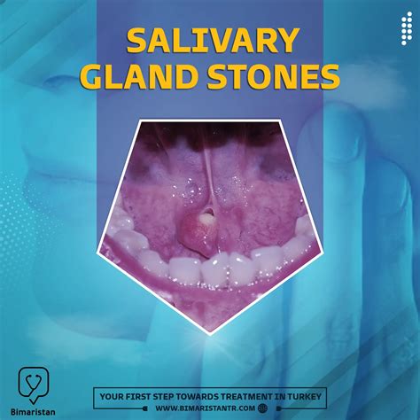 Treatment of salivary gland stones in Turkey and the reasons for their appearance - Bimaristan