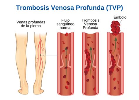 Síntomas Y Tratamiento De La Trombosis Venosa Profunda