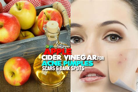 Apple Cider Vinegar for Acne, Pimples, Scars. 5 Ways to Use Apple Cider Vinegar for Acne ...