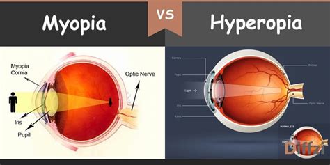 myopia vs hyperopia – Diffzi