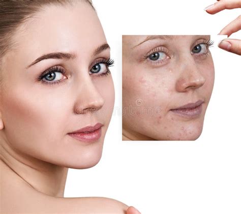 Woman Shows Photo with Bad Skin before Treatment. Stock Photo - Image ...