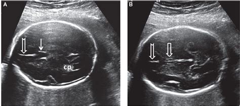 Normal Fetal Brain Ultrasound