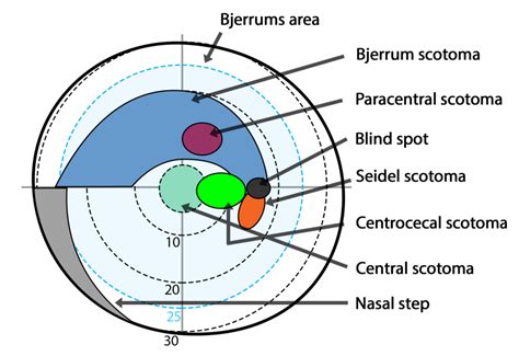 Different Types of Scotoma: Symptoms & Causes