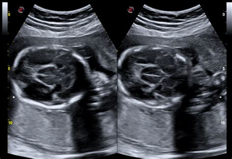 Holoprosencephaly Ultrasound