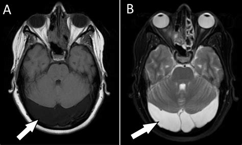 Cureus Bilateral Retrocerebellar Arachnoid Cysts Presenting As | SexiezPicz Web Porn