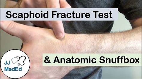 Scaphoid Fracture Test (Clinical Exam) and the Anatomic Snuffbox - YouTube