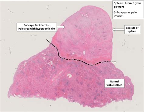 Spleen – Infarct – NUS Pathweb :: NUS Pathweb