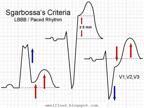 ECG Case 045 • LITFL • ECG Top 100 Self-Assessment Quiz