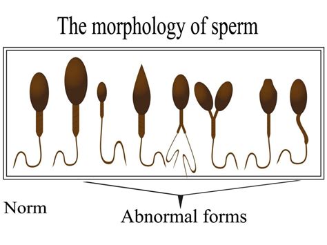 Poor Sperm Morphology | Private IVF Wandsworth | Concept Fertility